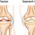 Симптомы и лечение подагры коленного сустава