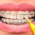 Что нужно знать перед постановкой брекетов: от первой консультации до ухода за зубами после установки