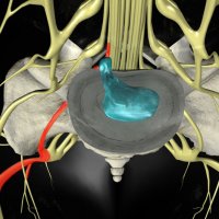 Дорзальная грыжа диска: что это такое?