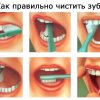 Лечение кариеса: как сохранить здоровье своих зубов