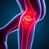 Ювенильный идиопатический артрит и поражение коленей: терапия — как вернуть ребенку подвижность