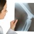 В каких случаях нужен рентген коленного сустава, и что показывает снимок?