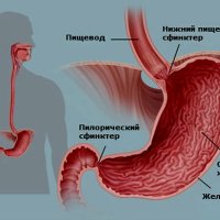 Недостаточность пилоруса желудка: причины, симптомы и способы лечения