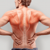 Миозит мышц спины: симптомы и лечение