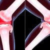 Асимметрия коленных суставов: когда это патология и когда можно не волноваться