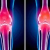 Высокое стояние надколенника (patella alta): риски и тактика, которые нужно знать