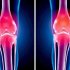 Высокое стояние надколенника (patella alta): риски и тактика, которые нужно знать