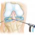 Артроскопия коленного сустава: суть методики