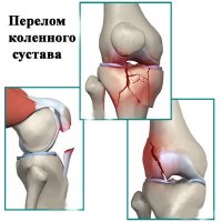 Срочная помощь и лечение при переломе колена