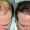 Пересадка волос: методы и их применение