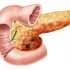 Лечение панкреатита: ключевые аспекты, советы и рекомендации