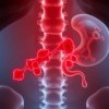 Гепатит С и криоглобулинемический васкулит: как инфекция отражается на суставах