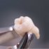 Виды удаления зубов