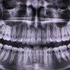 Что такое ОПТГ зубов?