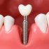 Имплантация одного зуба: как это делается, чего ждать и стоит ли идти на этот шаг