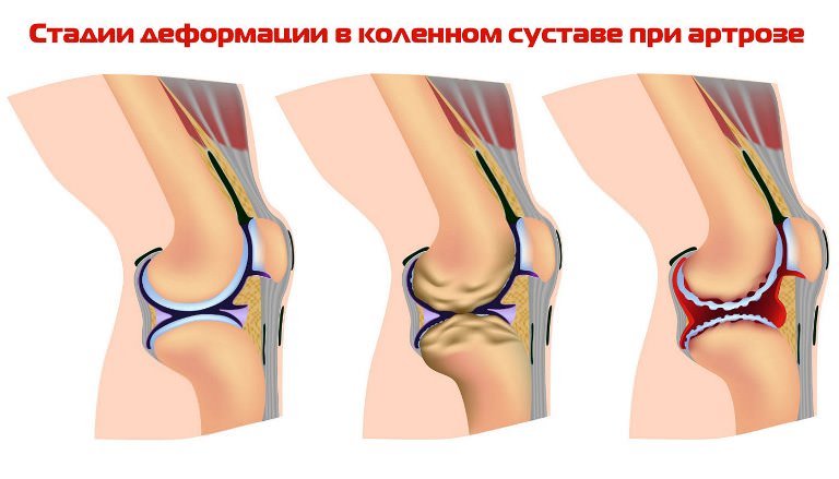 Деформации при артрозе колена