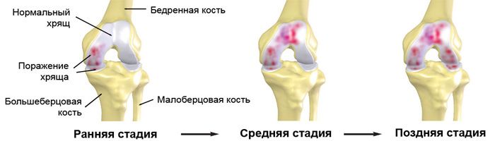 Стадиии артроза коленного сустава
