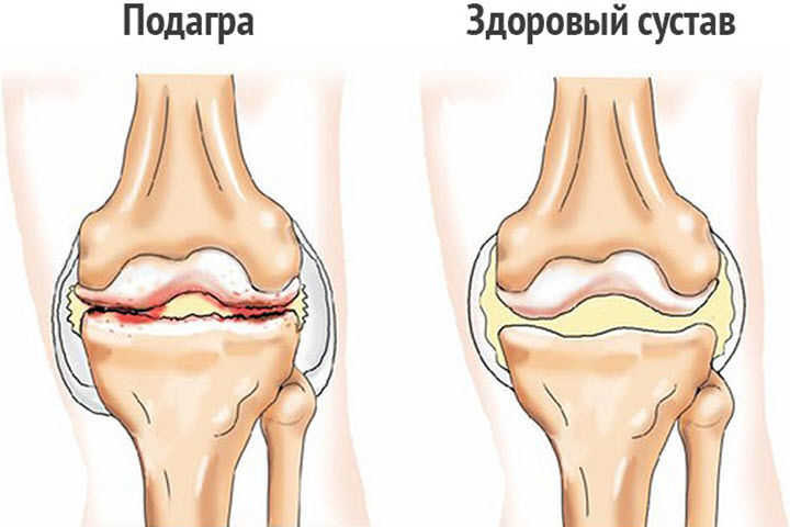 Подагра коленного сустава