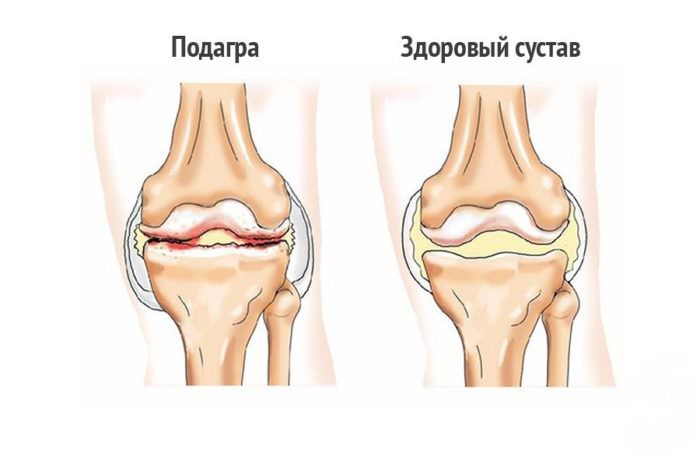 Подагрическая болезнь в колене
