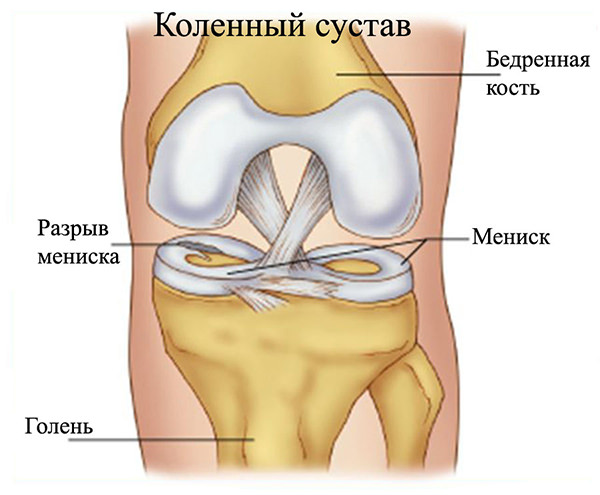 Мениск коленного сустава чем лечить