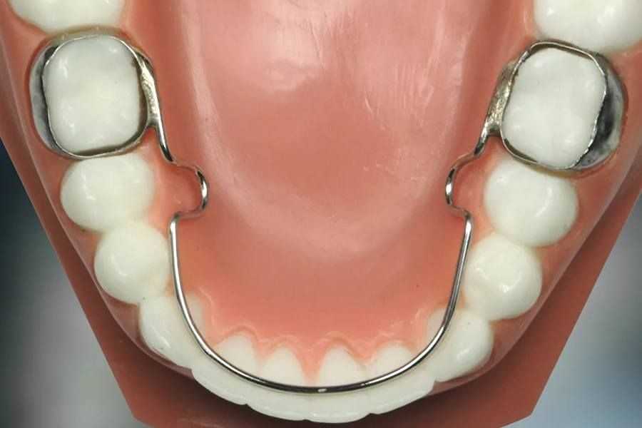 Что такое ретейнеры для зубов?