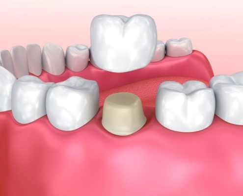 Как устанавливаются зубные коронки?
