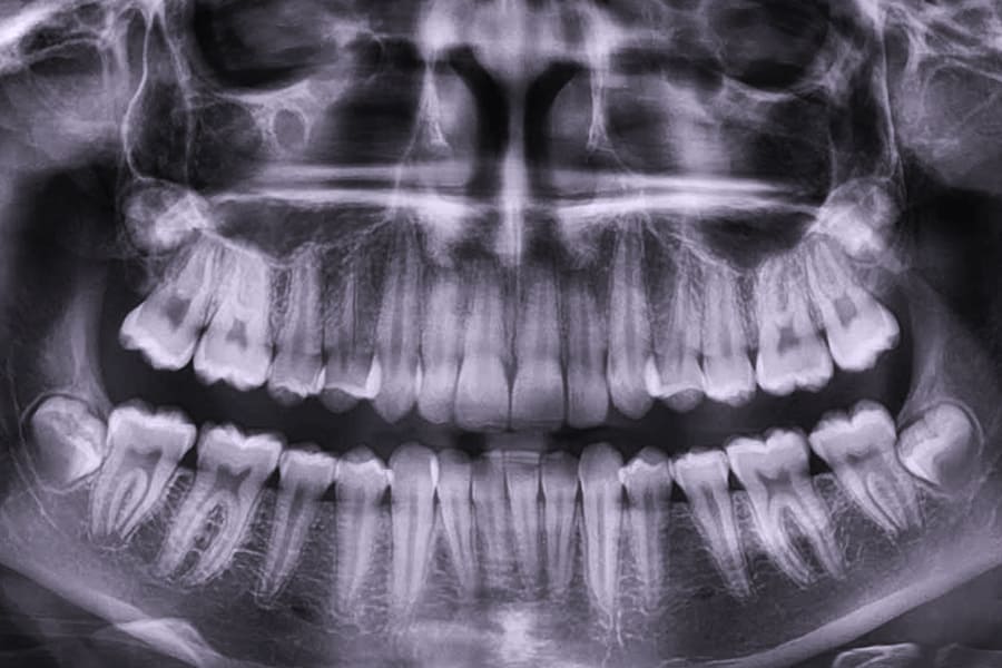 Что такое ОПТГ зубов?