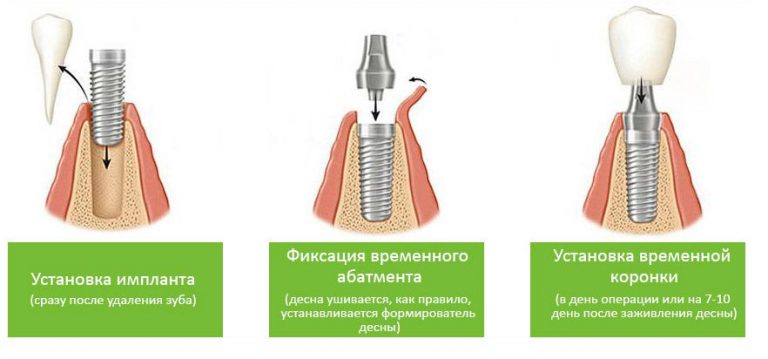 Как ставят имплант зуба пошагово с фото