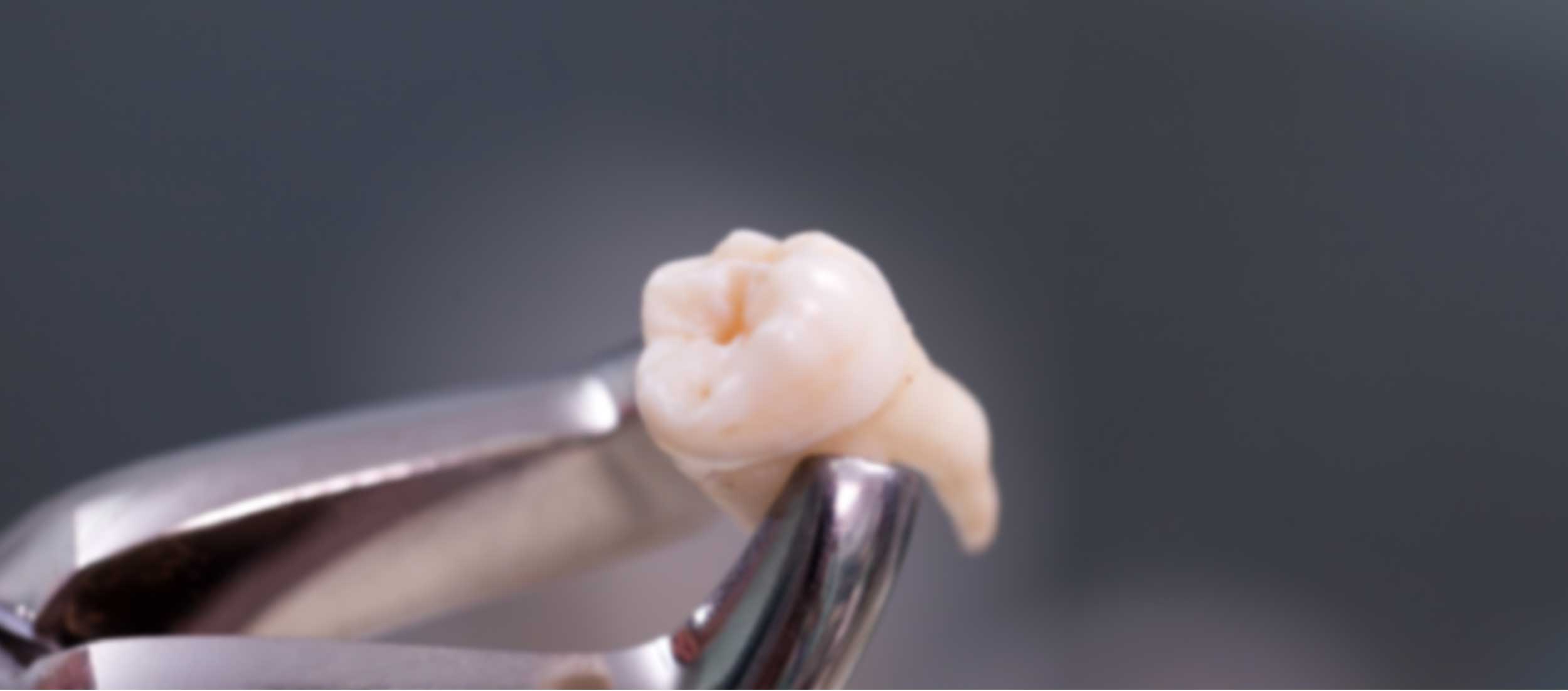 Виды удаления зубов
