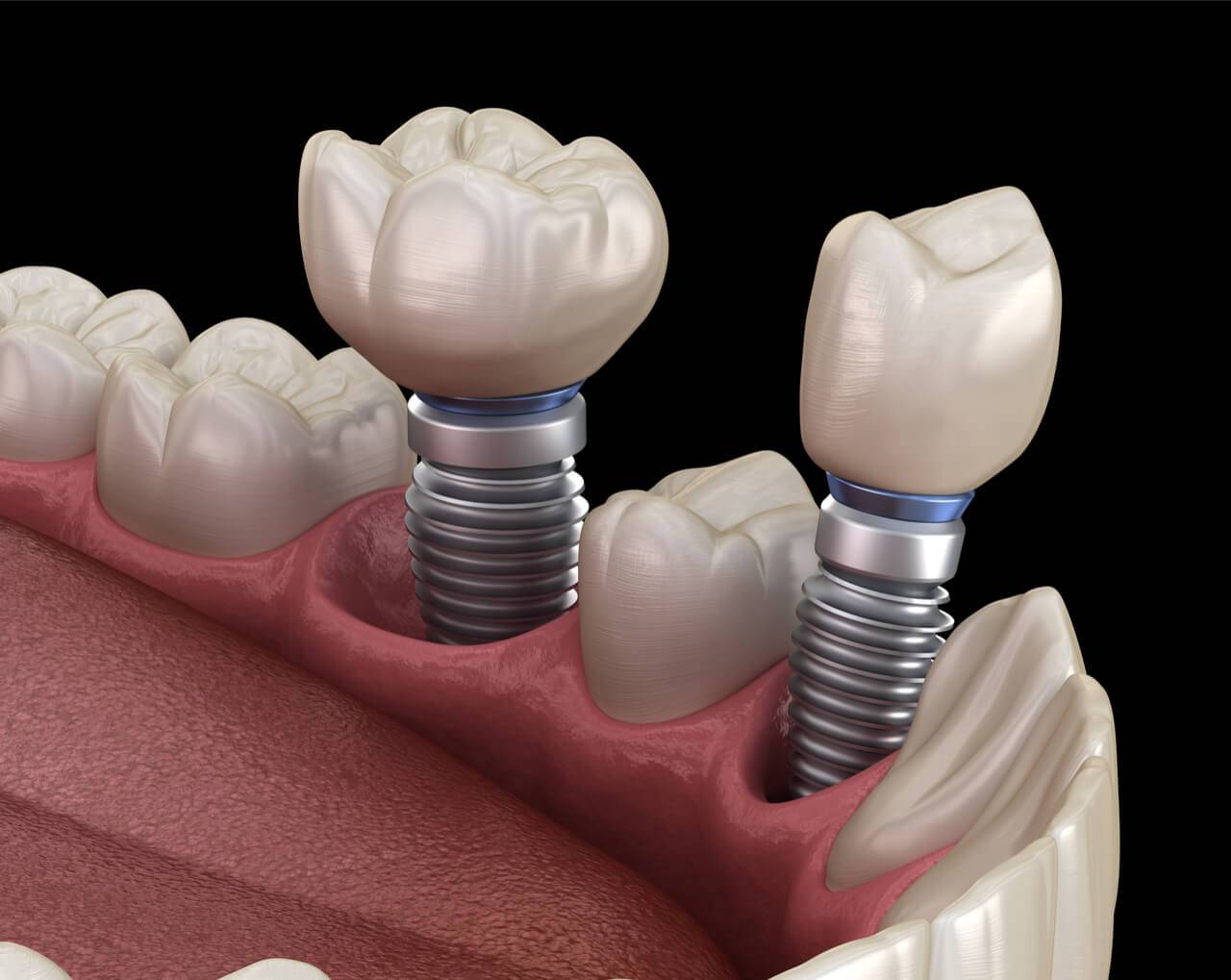Что представляют собой зубные импланты?