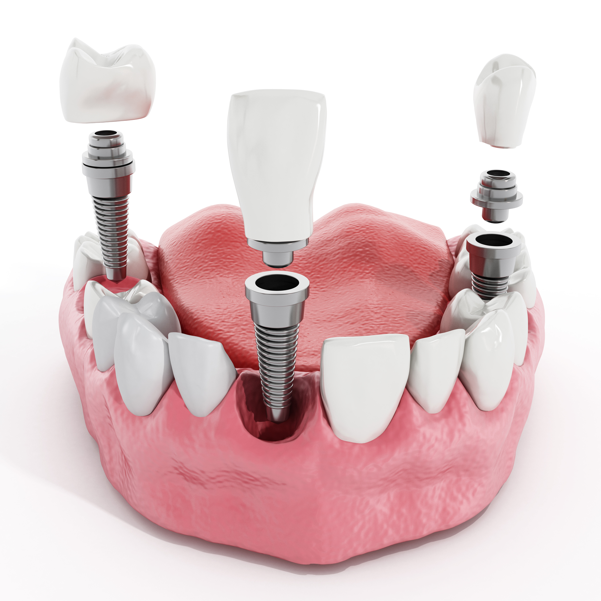 Что представляют собой зубные импланты?