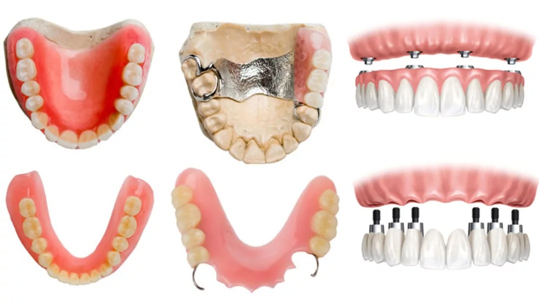 Какие бывают зубные протезы?