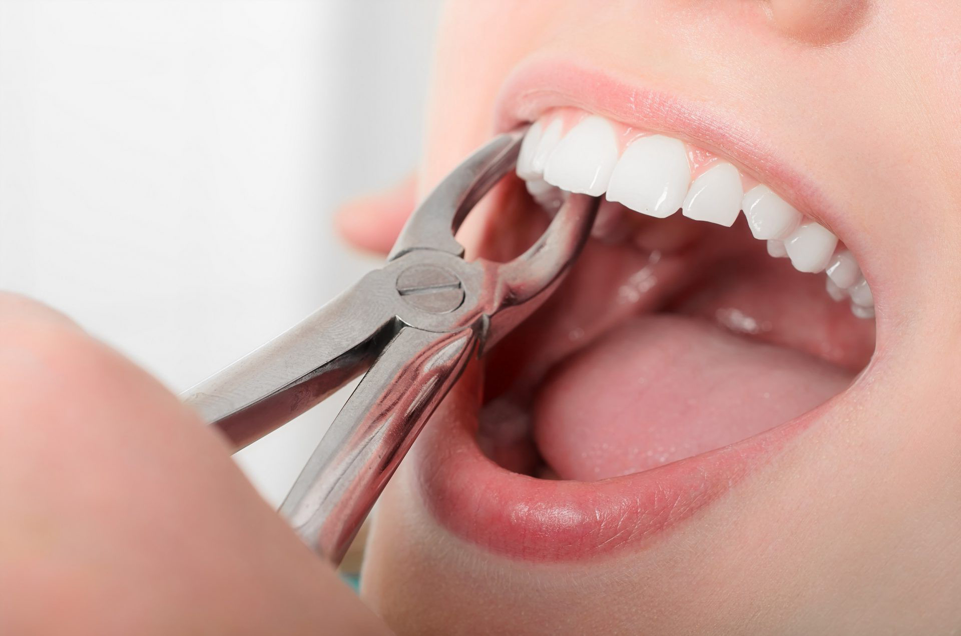 Процедура удаления зуба