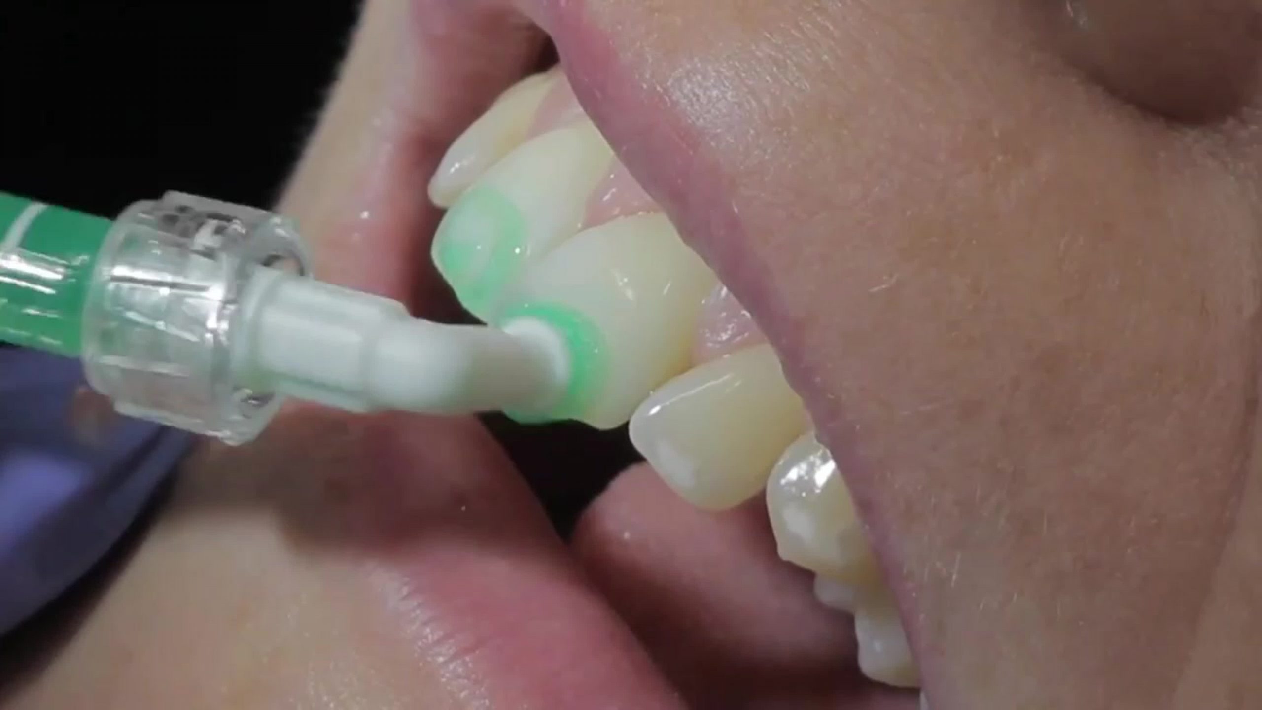 Лечение прикорневого кариеса: как избежать проблем и сохранить здоровье зубов