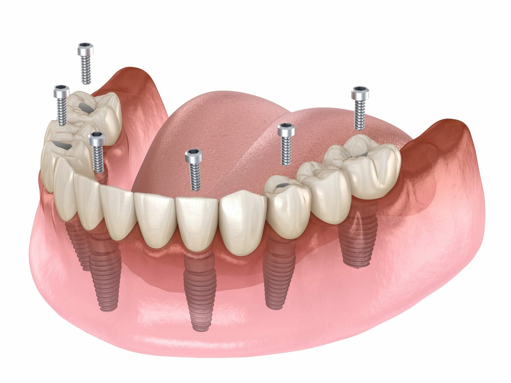 Имплантация All-on-4: Революционный подход в стоматологии